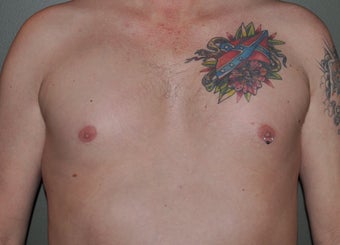 Pec Implants after 521679