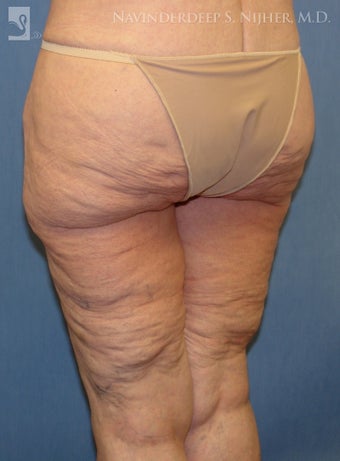 Backlift before 502541