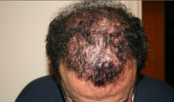Hair Transplant before 387806