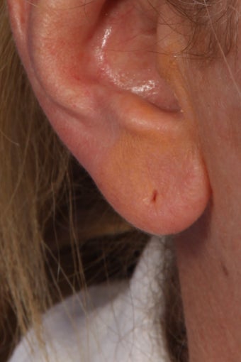 Juvederm Ultra Plus to Earlobes after 308311