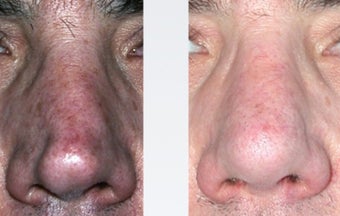 Rhinoplasty Nasal Reconstruction before 346256