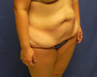Body Lift 460718