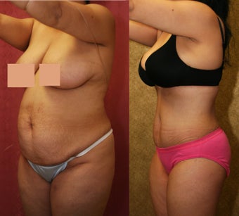 abdominoplasty- tummy tuck 468831