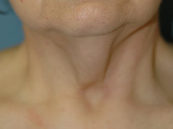 Neck Lift 542319