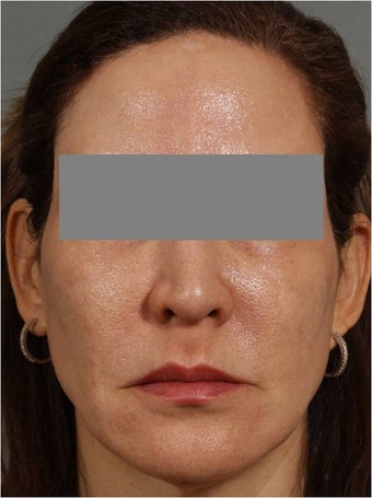 47 year old female treated for melasma, age spots, large pores and rough skin texture after 645449
