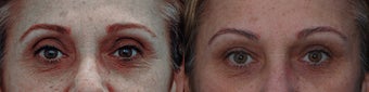 Upper eyelid filler with restylane before 323782