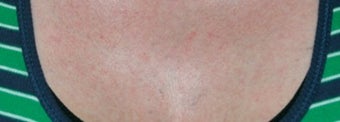 Laser tattoo removal after 374507