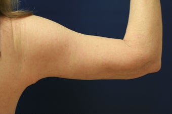 Arm lift (brachioplasty) 548317