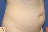 Smart Lipo before 606728