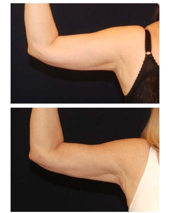 Liposuction before 286792