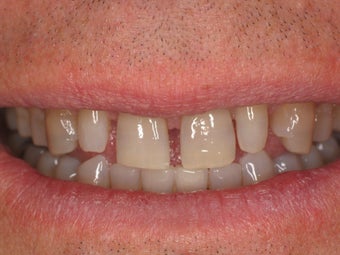 Porcelain Veneers 366635