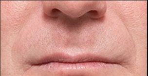 Restylane® before 388348