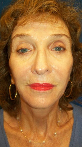 Sculptra after 336917