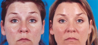Botox after 574299