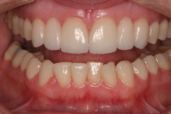 porcelain bridges after 336724