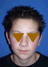 Ear Surgery (Otoplasty) 357647