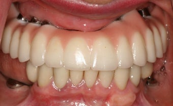 Upper Zirkonia hybrid prosthesis after 572616