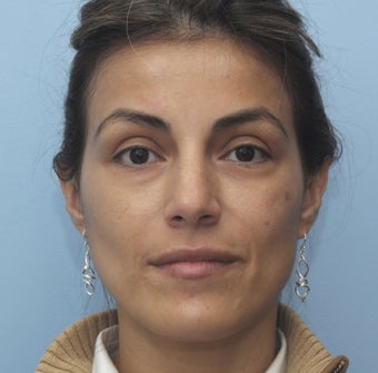 Eye Dermafillers,Cheek Dermafillers,Facial Dermafillers after 454584
