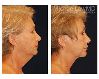 Facial Rejuvenation 395177