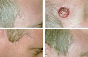 MOHS Skin Cancer Surgery before 369212