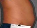 Liposonix 582725