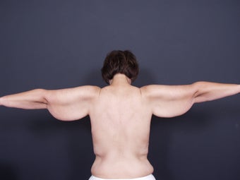 42 year old with sagging arm skin before 626307