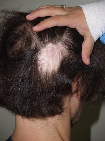 Hair Transplant to Prior Scar before 331296