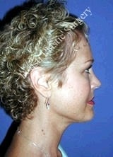 Liposuction 602753