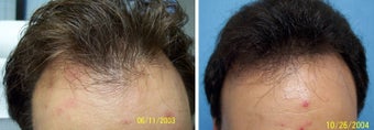 Medical treatment for hair loss (no surgery) before 369189