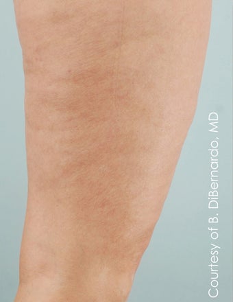 Smart Lipo after 606717