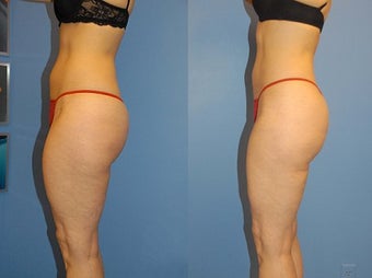 Liposuction before 636184