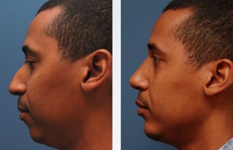 Rhinoplasty before 314275