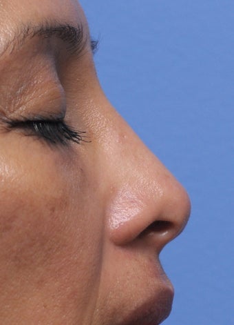 Non Surgical Rhinoplasty 407855