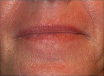 Active & Deep FX ~ CO2 Laser Skin Resurfacing after 130744