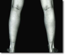 Calf Implant 566015