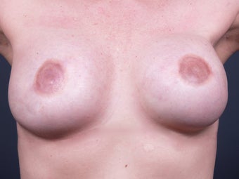38 Year Old for Breast Reconstruction after 643170