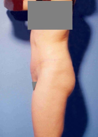 Abdominoplasty after 356387