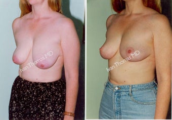 Mastopexy-Breast Lift before 243700