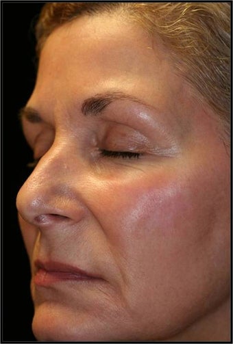 Fraxel - Melasma after 652343