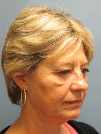 Brow Lift, Eyelid Lift 519165