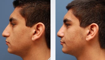Rhinoplasty before 346243