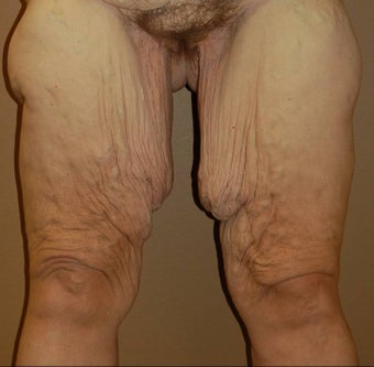 thigh lift before 260533
