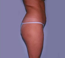 Smartlipo 401661