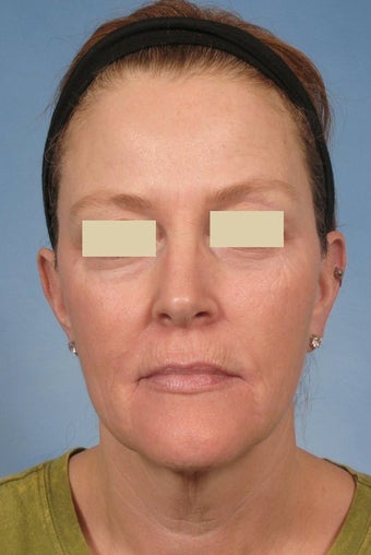 Phenol Peel before 125532