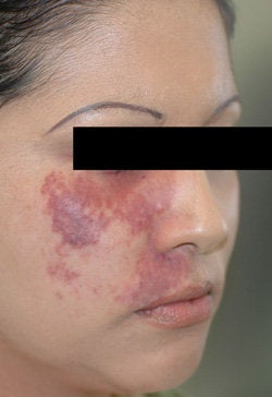 Port Wine Birthmark Removal with Pulsed Dye Lasers before 104204