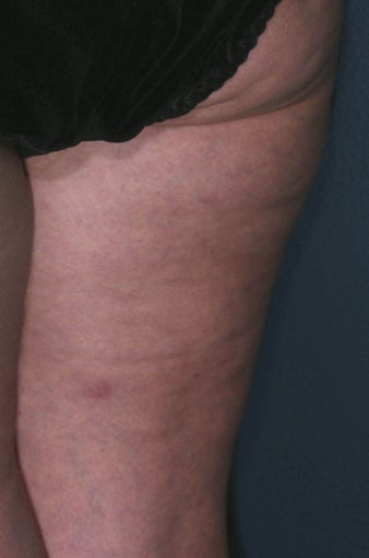 Cellulite treatment after 113275