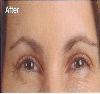 Botox after 395287