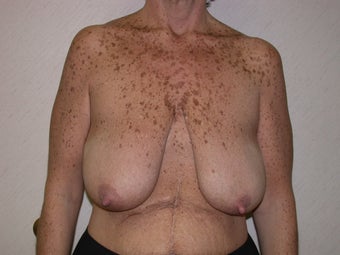 Breast Lift Surgery before 104552