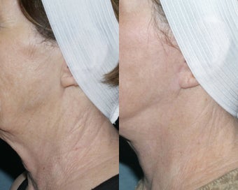 Fraxel repair for neck with laser peel treatment before 104649