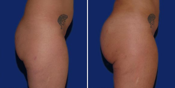 Brazilian Butt Lift before 494509